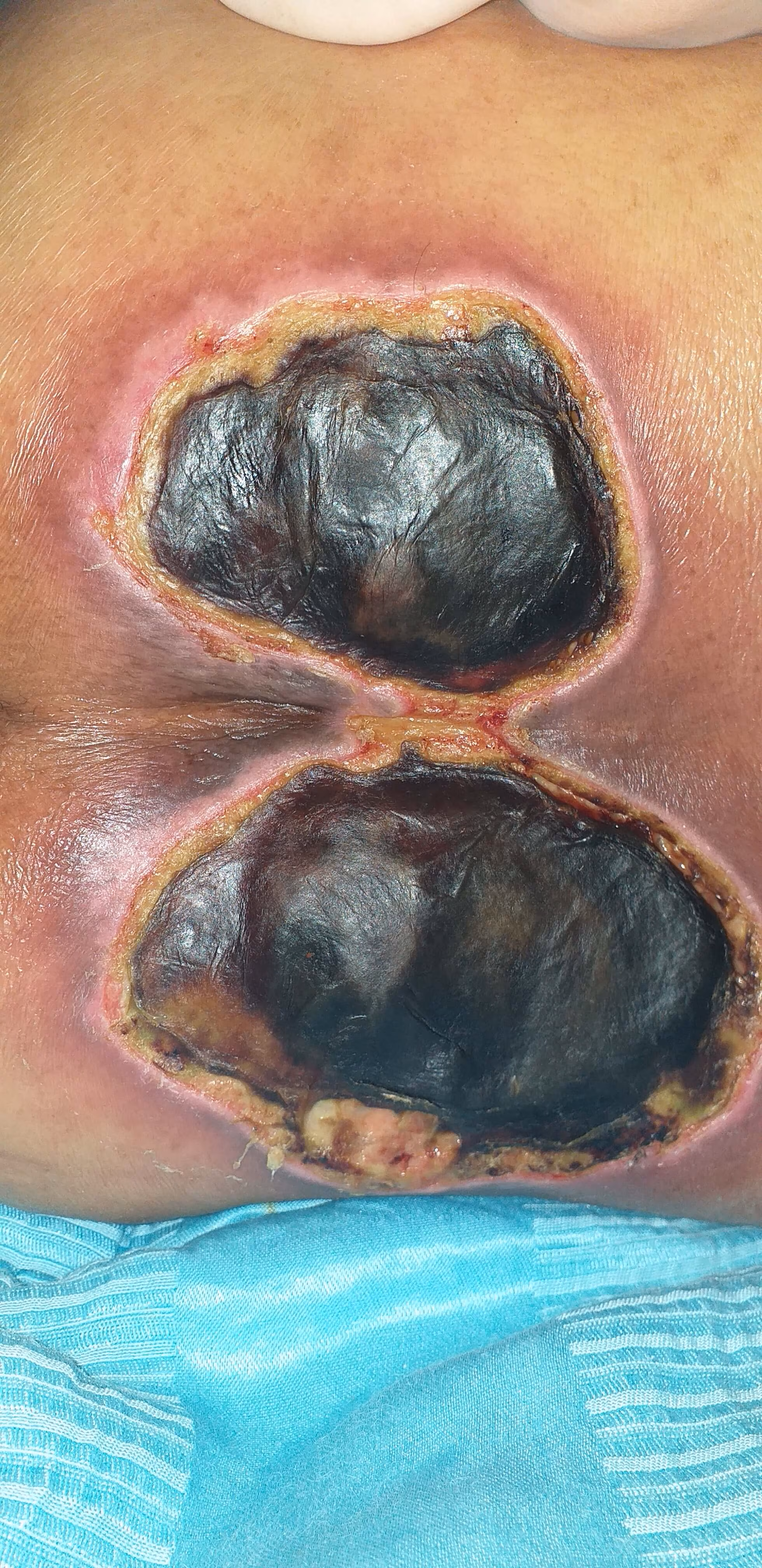 درمان زخم بستر سیاه شده