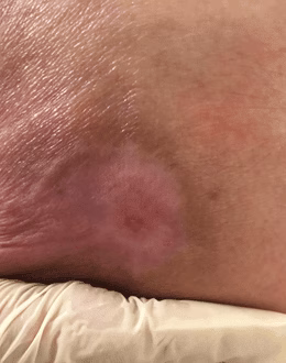 در مان زخم بستر در منزل