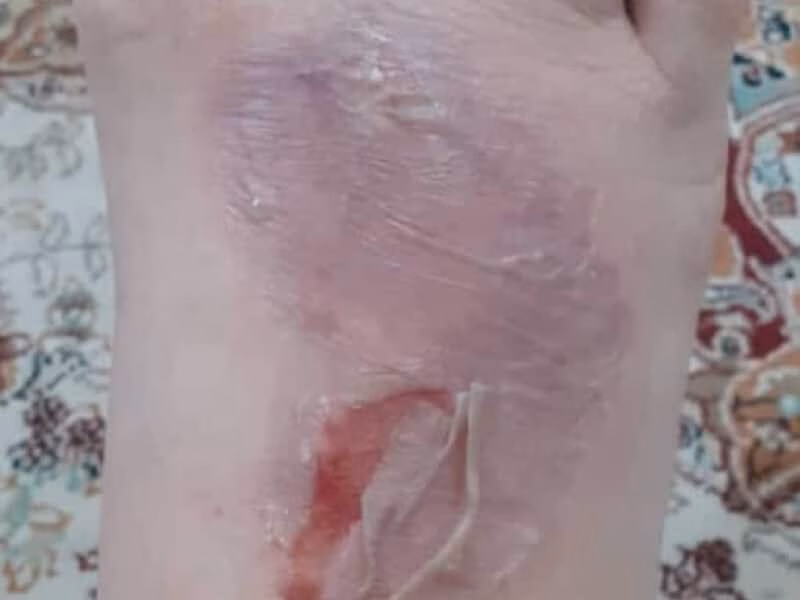 درمان تاول دیابتی زخم تراپیست