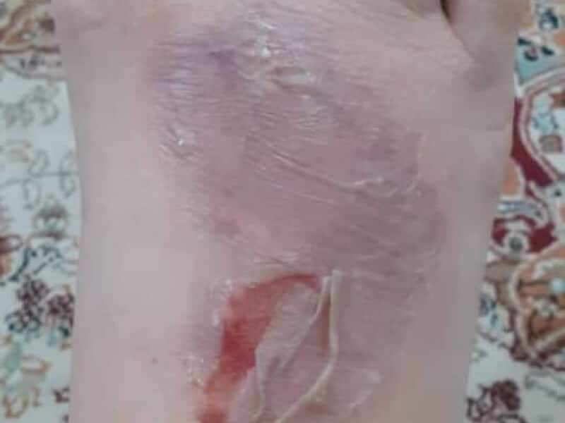 درمان تاول پای دیابتی عفونی