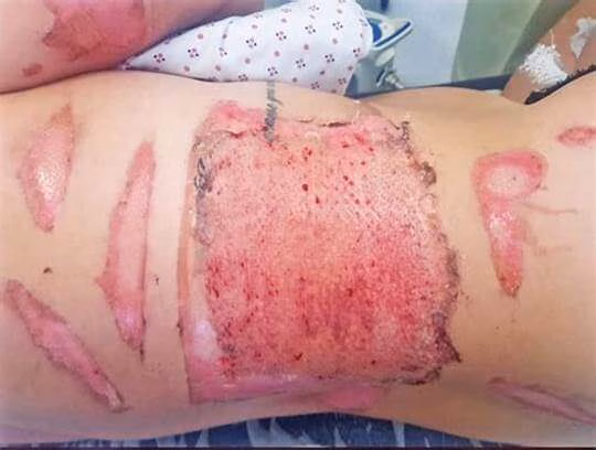 انواع زخم های سوختگی و روش درمان زخم سوختگی