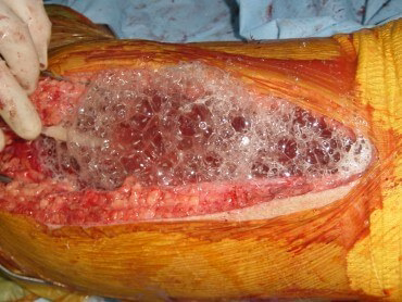 قیمت پانسمان و درمان زخم در منزل