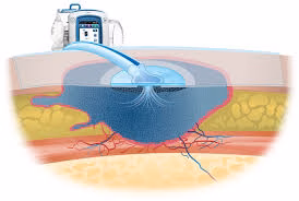 هزینه هر جلسه وکیوم تراپی