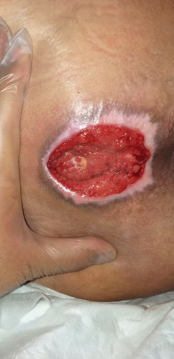 برای درمان زخم بستر در منزل چیکار کنیم