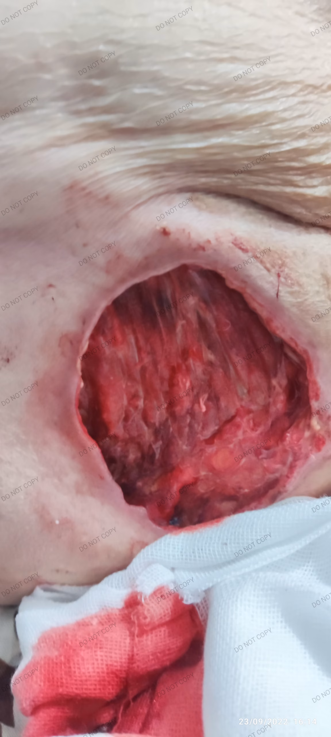 بهترین و سریع ترین درمان زخم بستر