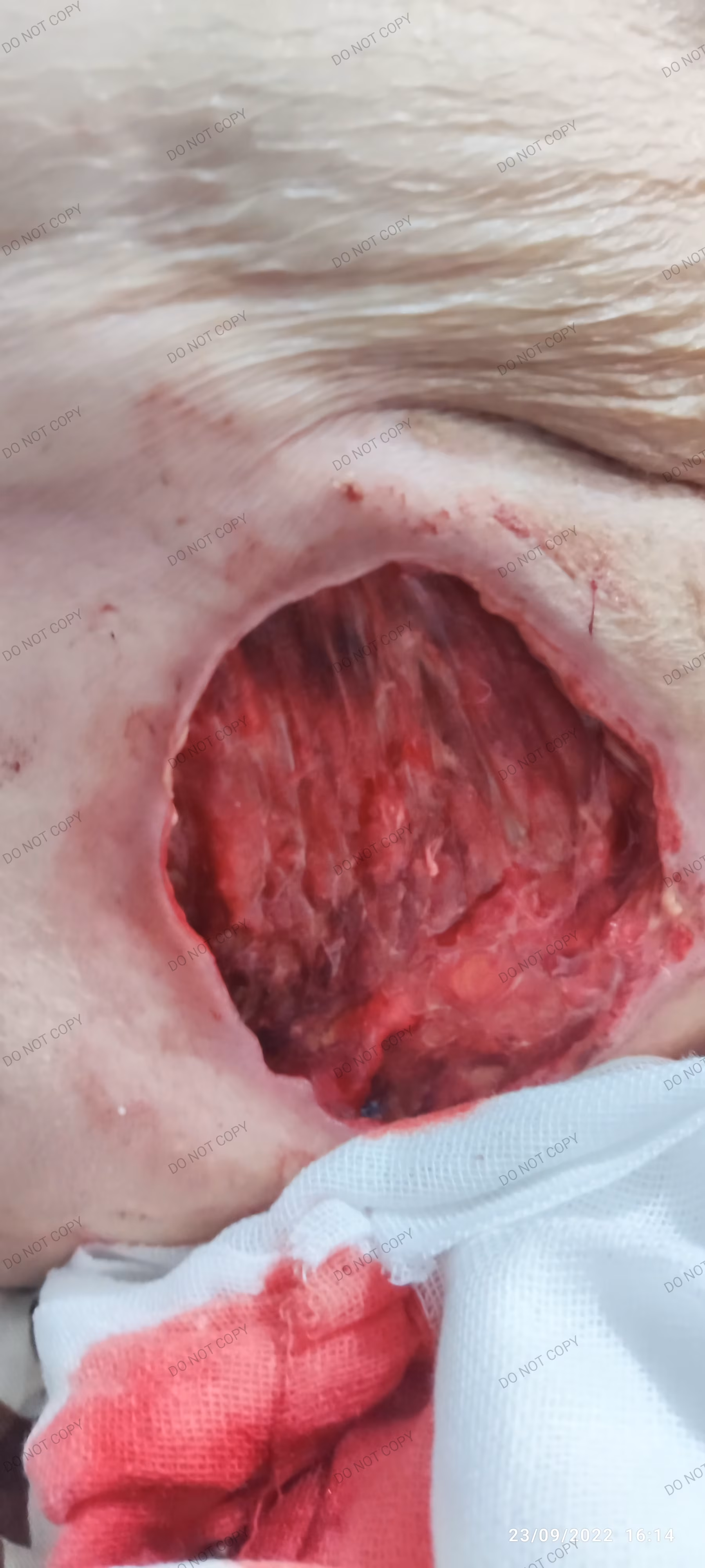 بهترین و سریع ترین درمان زخم بستر