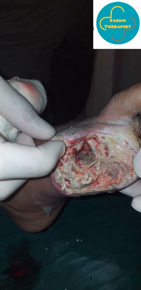 تعویض پانسمان در منزل