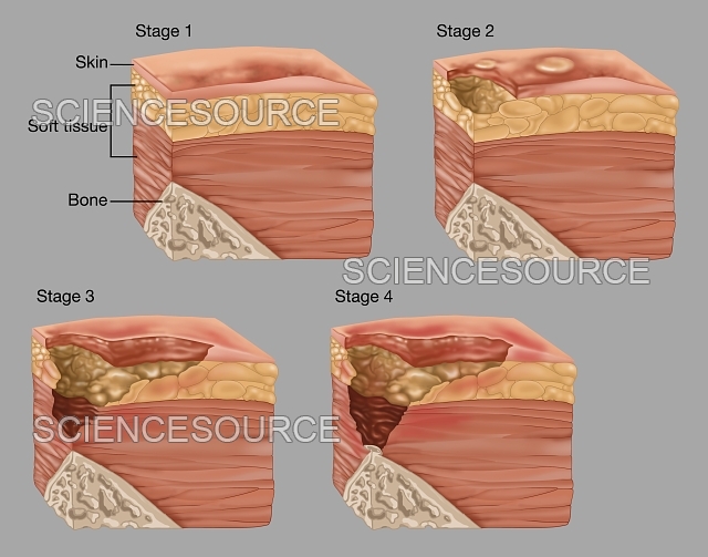 درمان زخم بستر در تهران