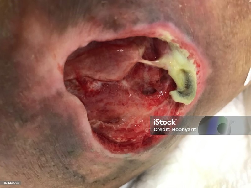 زخم بستری که در مراحل ابتدایی اقدام درمانی انجام نداده است