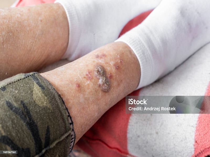 سریعترین روش های درمان زخم دیابتی در منزل در سال ۱۴۰۴