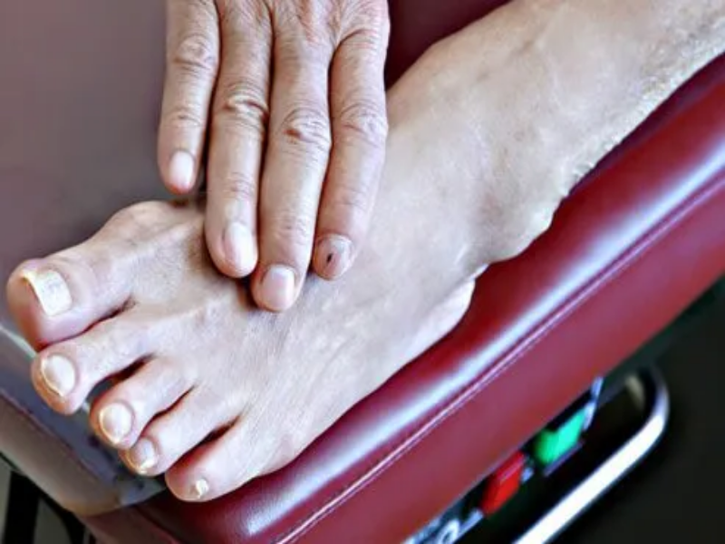 چک کردن انگشتان پای دیابتی 