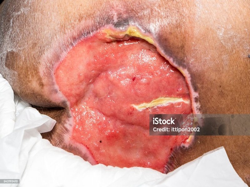 درمان فوری زخم بستر با پانسمان های تخصصی توسط کارشناس زخم