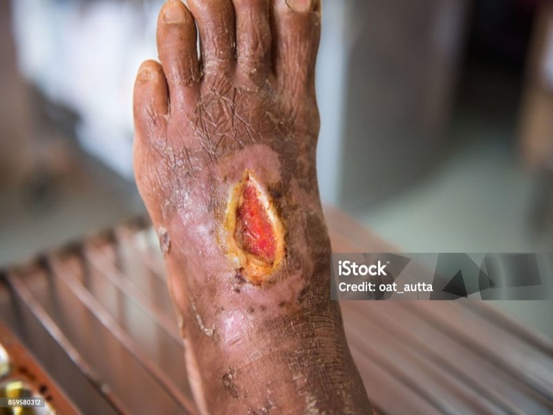 برای درمان زخم دیابت کجا برم