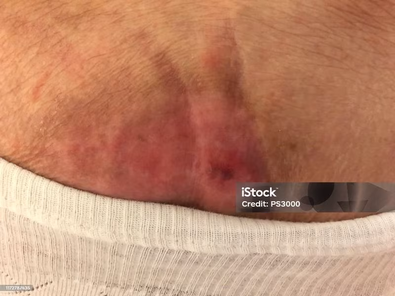 پانسمان زخم بستر | چیتگر + اعزام 30 دقیقه ای متخصص زخم