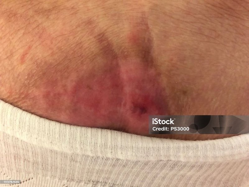 درمان تخصصی زخم بستر|سعادت آباد+شهرک غرب+اعزام 30 دقیقه ای کارشناس زخم