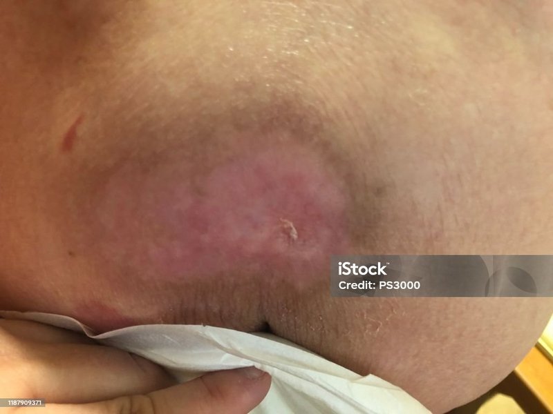 درمان سریع زخم بستر در سالمندان