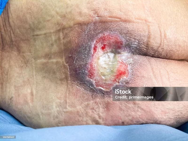 پانسمان تخصصی زخم بستر | جردن + الهیه + اعزام 1 ساعته متخصص زخم