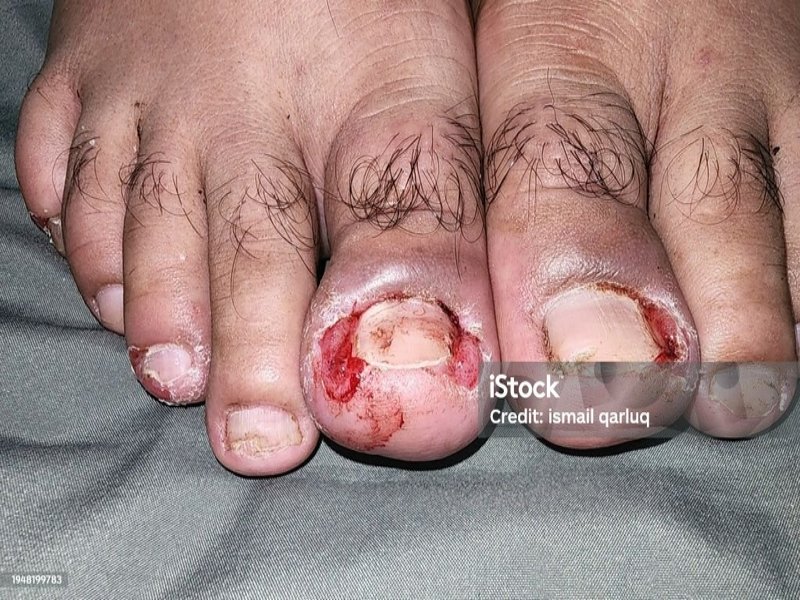 درمان زخم جراحی