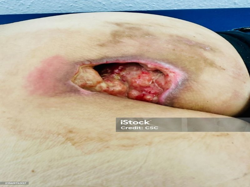 اصول مراقبت از زخم بستر