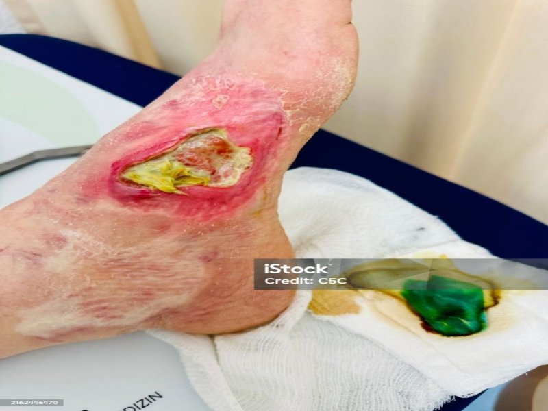 درمان تخصصی زخم دیابتی|شهرک غرب+سعادت آباد+اعزام 30 دقیقه ای کارشناس زخم