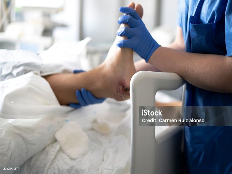 درمان تخصصی زخم بستر|سعادت آباد+شهرک غرب+اعزام 30 دقیقه ای کارشناس زخم